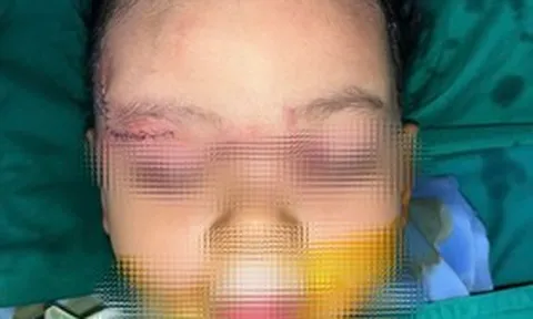 Bé 22 tháng tuổi bị chó cắn: Bác sĩ xử trí nhanh, hạn chế biến chứng