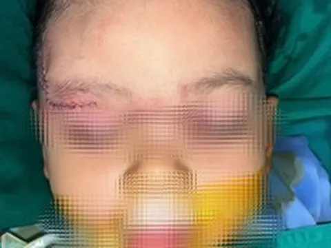 Bé 22 tháng tuổi bị chó cắn: Bác sĩ xử trí nhanh, hạn chế biến chứng